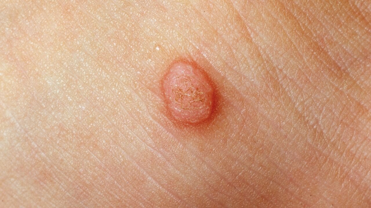 تفاوت خال گوشتی و زگیل چیست؟/ آیا کندن  زگیل با ناخنگیر یا بستن نخ خطرناک است؟