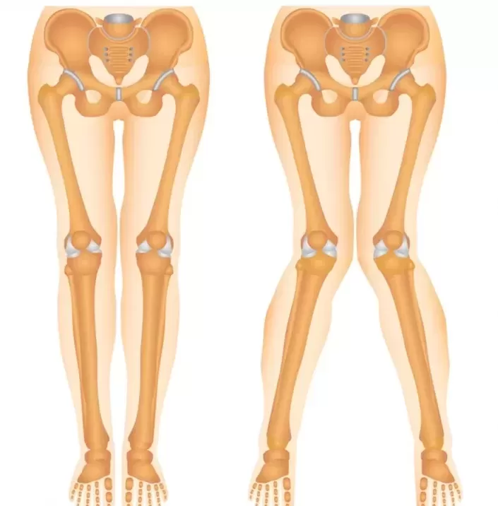 زانوی ضربدری