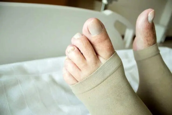 علائم هشداردهنده لخته‌ شدن خون در پا را بشناسید