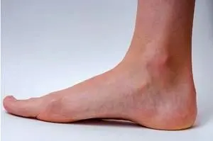 یک راهکار مناسب برای پیشگیری از واریس